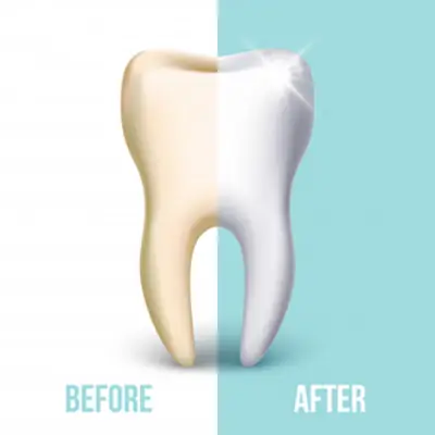 Teeth Whitening_