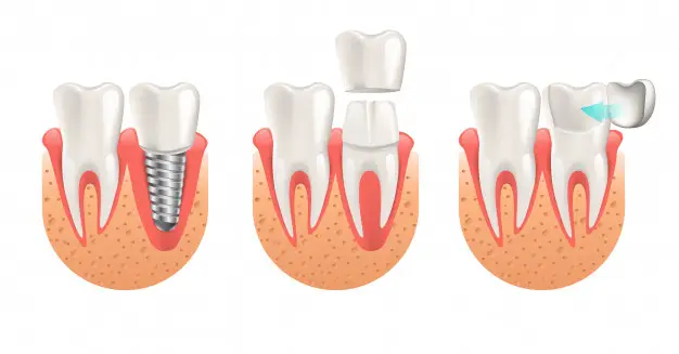 Veneers-Laminates